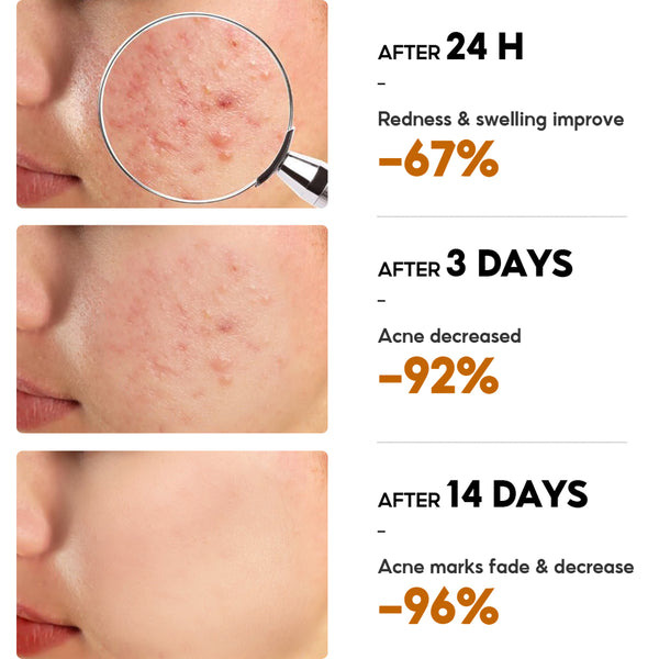 VIBRANT GLAMOUR Herbal Acne Treatment Cream 30g