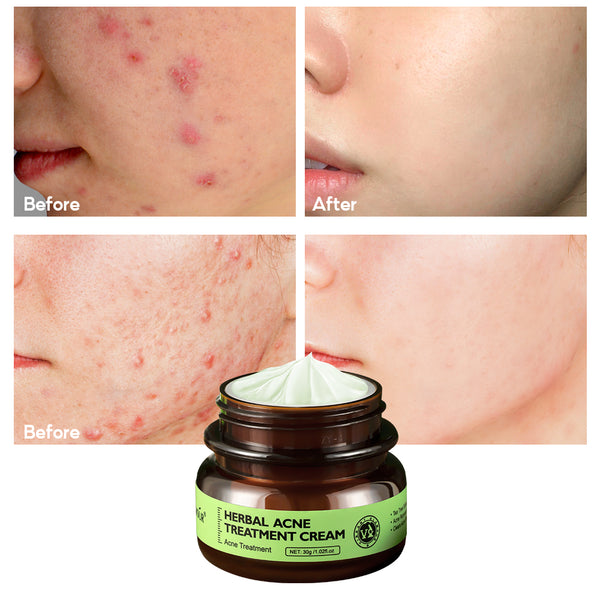 VIBRANT GLAMOUR Herbal Acne Treatment Cream 30g