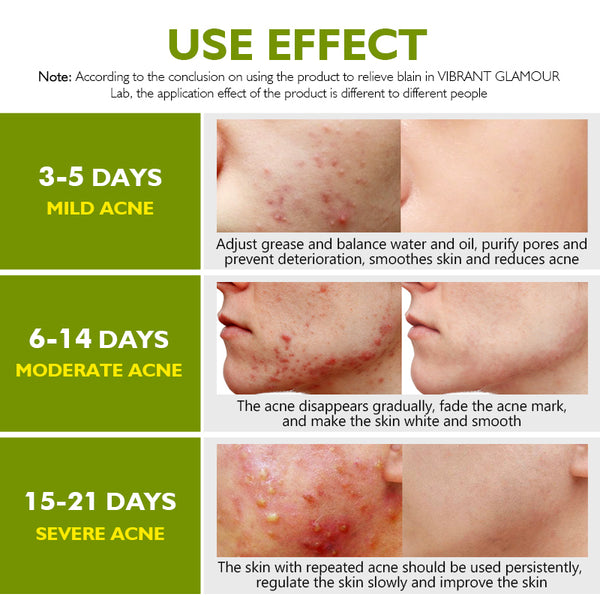 VIBRANT GLAMOUR Herbal Acne Treatment Set Tea Tree Oil Acne Pimples Removal 4PCS