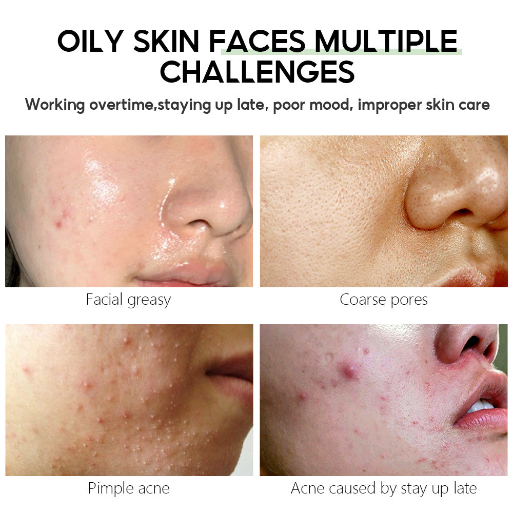 VIBRANT GLAMOUR Herbal Acne Treatment Toner Reduce Pimple 100ml 